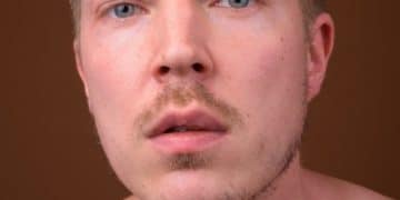 Acne Scar Solutions for Men: Peels vs. Microdermabrasion - Cover Image